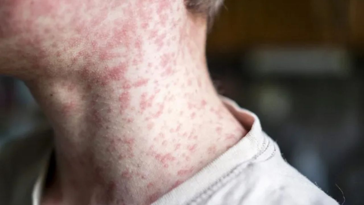 Measles Cases Rise to 11 in North Dakota as Pembina County Reports New Infections