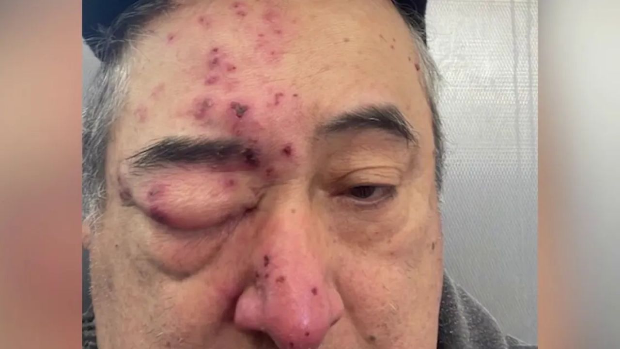 Rogers Park Tenant Claims Rat Bit His Face While Sleeping